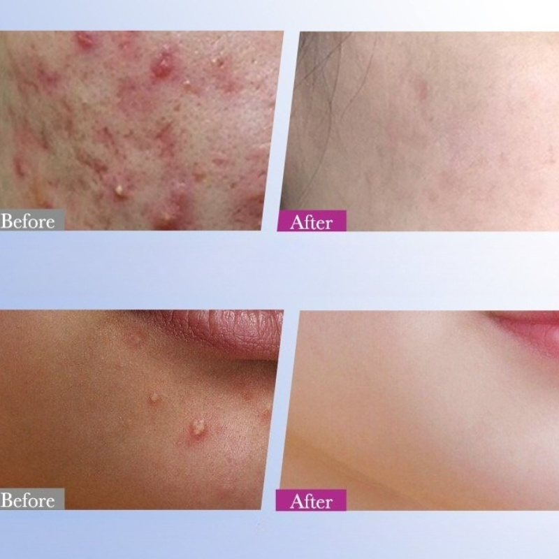 7/10/14Pcs Colorful Star Acne  - Skincare Qv incelemesi ve fiyatı