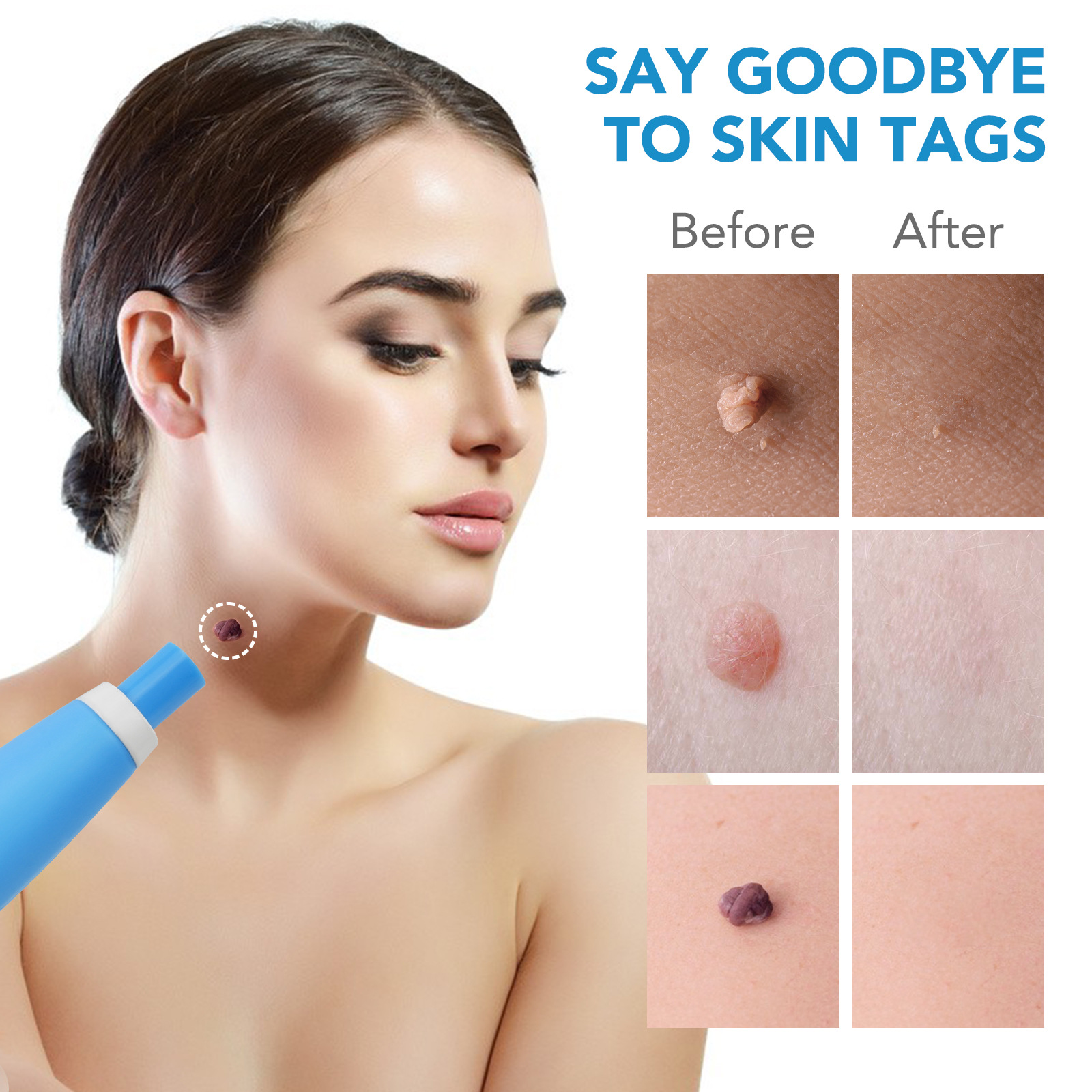 2 IN 1 Auto Skin Tag Remover K - Skincare Qv incelemesi ve fiyatı